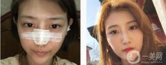 所以很多人對(duì)自己的鼻子不滿(mǎn)意，甚至有人選擇做隆鼻來(lái)達(dá)到美觀的效果