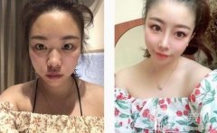 醫(yī)生說我的鼻子需要抬高鼻梁，然后縮小鼻子