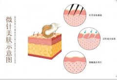 微針調(diào)節(jié)間隔時(shí)間的醫(yī)美知識(shí)