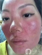 激素臉：癥狀、排毒與修復(fù)的探索