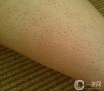 擺脫“雞皮膚”：理解、預防與調(diào)節(jié)