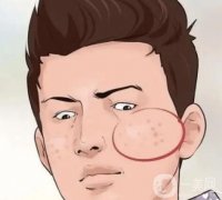 男士祛痘：戰(zhàn)斗痘疤，重拾自信