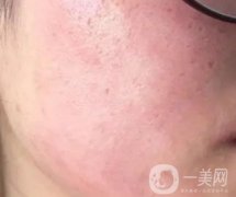 臉部化妝品過敏怎么辦：解決搓泥現(xiàn)象的策略