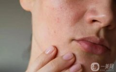 肌膚危機(jī)：不規(guī)律作息與油膩飲食的后果