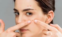 明星也逃不過痘痘的困擾，解析痘痘類型及預防方法