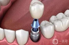 種植牙多少錢一顆價格表2023公布，了解種植牙費用及影響因素