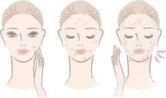 痘痘已經(jīng)平了一直紅著