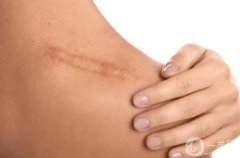 阿嬌傷勢(shì)恢復(fù)，淡化疤痕有妙招!從成因找方法，讓疤痕無跡可痕