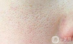 深入了解毛孔粗大原因及改良方法