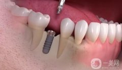 邵陽(yáng)一顆種植牙要多少錢？收費(fèi)價(jià)格表公布，一鍵查收