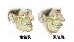 凸嘴正頜手術(shù)多少錢？手術(shù)時(shí)間、注意事項(xiàng)介紹詳細(xì)