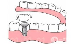 鄭州種植牙價格貴不貴？多少錢？全新口碑牙科醫(yī)院推薦