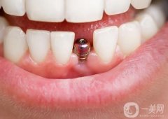 無錫種一顆牙價格多少錢？種植牙品牌怎么選？附五家靠譜醫(yī)院介紹