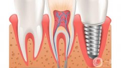 南昌種植牙多少錢一顆？價格費用概況解析，附高性價比醫(yī)院盤點