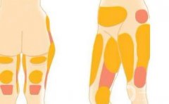 減肥抽脂術(shù)要多少錢？效果如何？盤點四家口碑醫(yī)院了解一下！