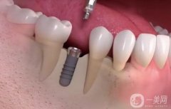 佛山種牙多少錢一顆?。績r格費用詳細_靠譜醫(yī)院測評3家