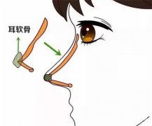 肋骨隆鼻多少錢？肋骨隆鼻和耳軟骨哪個好？醫(yī)院點評