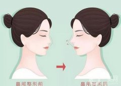 張軍醫(yī)生隆鼻案例分享，專家資料介紹、價格收費標(biāo)準(zhǔn)一覽