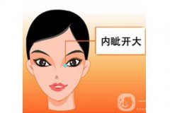 全切雙眼皮后如何快速消腫