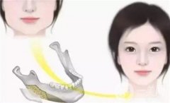 顴骨提升效果能維持多久？