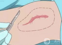 去除手術(shù)疤痕有哪些方法