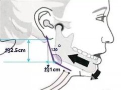 去除下頜角的手術(shù)方法有哪些？