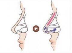 如何預(yù)防鼻翼縮小引起的增生？