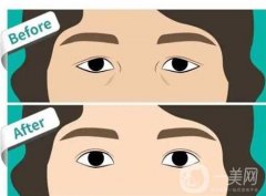 雙眼皮手術(shù)的危害有哪些