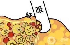 水動(dòng)力吸脂怎么樣，會(huì)導(dǎo)致皮膚松弛嗎