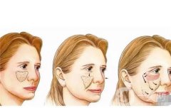 使用自體脂肪填充有什么好處？