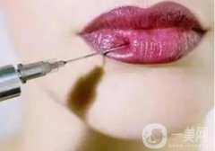 為什么豐唇術(shù)的效果不能長(zhǎng)久維持