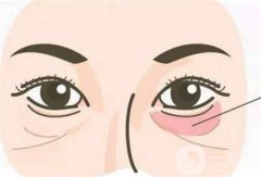 無(wú)痕去眼袋有哪些優(yōu)勢(shì)？哪些人適合