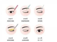 修復(fù)雙眼皮疤痕的價(jià)格是多少？