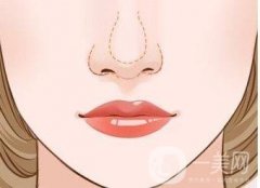 自體脂肪填充鼻唇溝效果如何