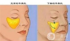 影響自體脂肪填充淚溝維持時間的因素有哪些？