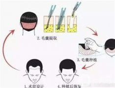 植發(fā)需要多長(zhǎng)時(shí)間才能看到效果？