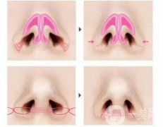 朝天鼻矯正后多久可以恢復(fù)