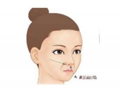 鼻翼切除術(shù)后怎么正確護(hù)理消腫