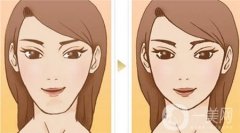 墊下巴的材料選擇及術(shù)后護(hù)理