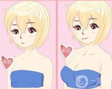 副乳切除術(shù)是否會影響乳房？