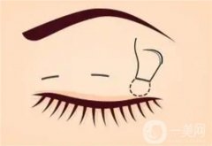 割雙眼皮和開眼角存在哪些不同？