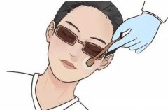 激光黑眼圈后的恢復(fù)期長(zhǎng)嗎