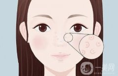 紅血絲去除后如何進(jìn)行護(hù)理？