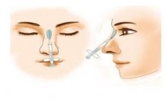 鼻孔縮小手術(shù)的后遺癥及適宜人群