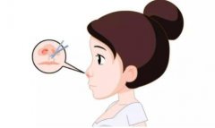 鼻孔縮小手術(shù)是否安全？是否有風(fēng)險