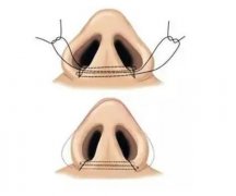 鼻頭縮小手術(shù)的風險及注意事項