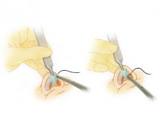 鼻尖矯正手術(shù)方法和步驟
