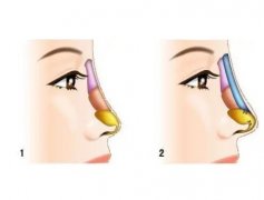 鼻部綜合手術(shù)后的感染癥狀