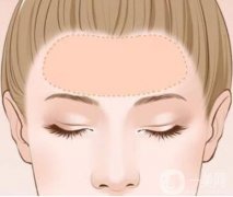 玻尿酸填充和自體脂肪填充的優(yōu)點(diǎn)