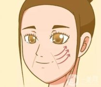 玻尿酸填充法令紋的優(yōu)點(diǎn)